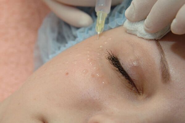 Mezoterapie - injekční metoda omlazení pokožky obličeje