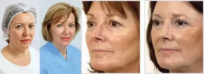Výsledkem omlazení pleti obličeje laserem je redukce vrásek