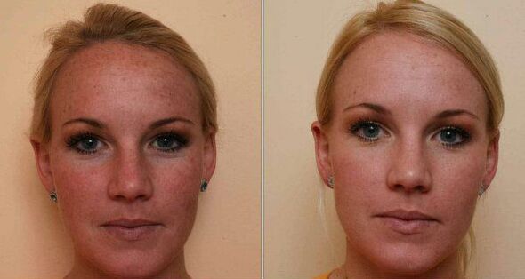 před a po omlazení pokožky obličeje laserem