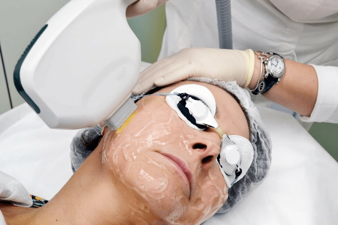 laserové omlazení pokožky obličeje