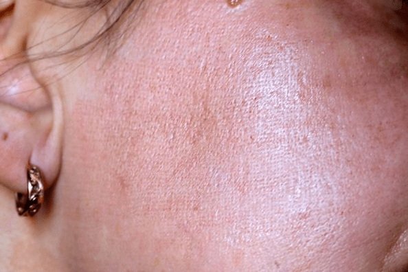 zarudnutí kůže po omlazení laserem